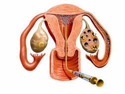 Descubra quais as condições para realizar a inseminação artificial | Mater Prime 